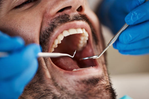 Best Emergency Wisdom Teeth Removal in Kalaeloa, HI